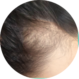 脫落髮絲數目異常