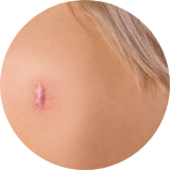 有蟹足腫體質的人士