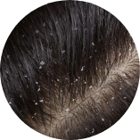 突然出現大量頭皮屑