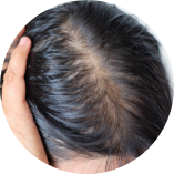 脂溢性脫髮