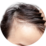 髮際線明顯後移