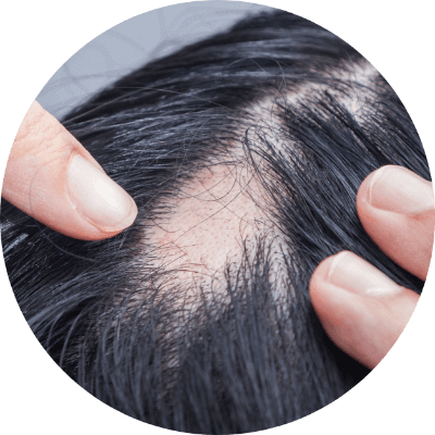 毛囊完全壞死的人士