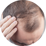 脫髮先兆