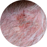 細菌性感染(毛囊炎)